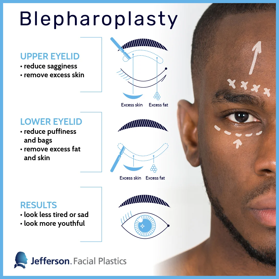 Jefferson Facial Plastics Blepharoplasty